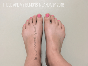 Bunionettes (Tailors Bunions) January 2018